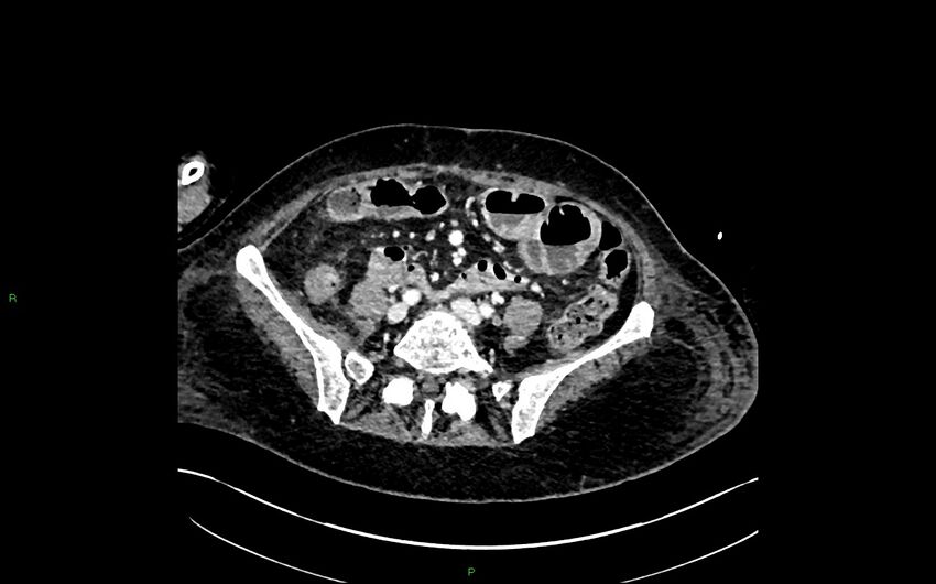 Neo-terminal ileal stricture (Crohn disease) (Radiopaedia 33790-34948 A 315).jpg