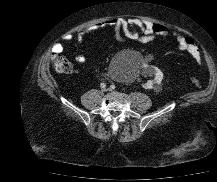 Nephroptosis with inguinal hernia containing perirenal fat (Radiopaedia 56632-63391 C 227).jpg