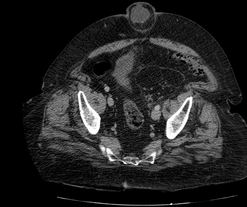 Nephroptosis with inguinal hernia containing perirenal fat (Radiopaedia 56632-63391 C 286).jpg