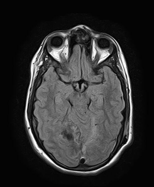 File:Neurofibromatosis type 2 (Radiopaedia 66211-75401 Axial FLAIR 14).jpg