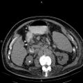 Non Hodgkin lymphoma in a patient with ankylosing spondylitis (Radiopaedia 84323-99621 Axial non-contrast 37).jpg
