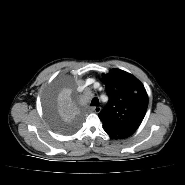 File:Non small-cell lung cancer (Radiopaedia 24467-24769 C+ delayed 18).jpg