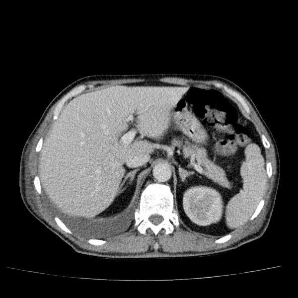 File:Non small-cell lung cancer (Radiopaedia 24467-24769 C+ delayed 60).jpg