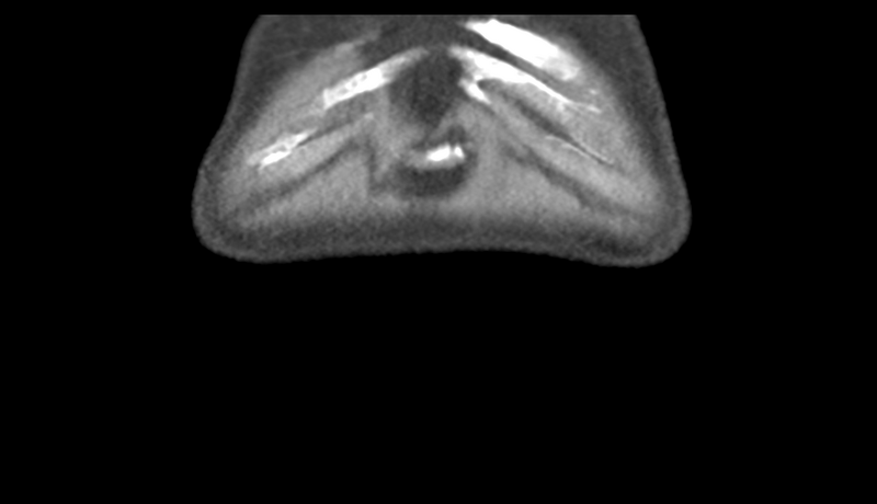 File:Normal CT intravenous cholangiogram (Radiopaedia 38199-40208 Coronal IVC 2).png