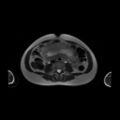 Normal MRI abdomen in pregnancy (Radiopaedia 88001-104541 Axial T2 37).jpg