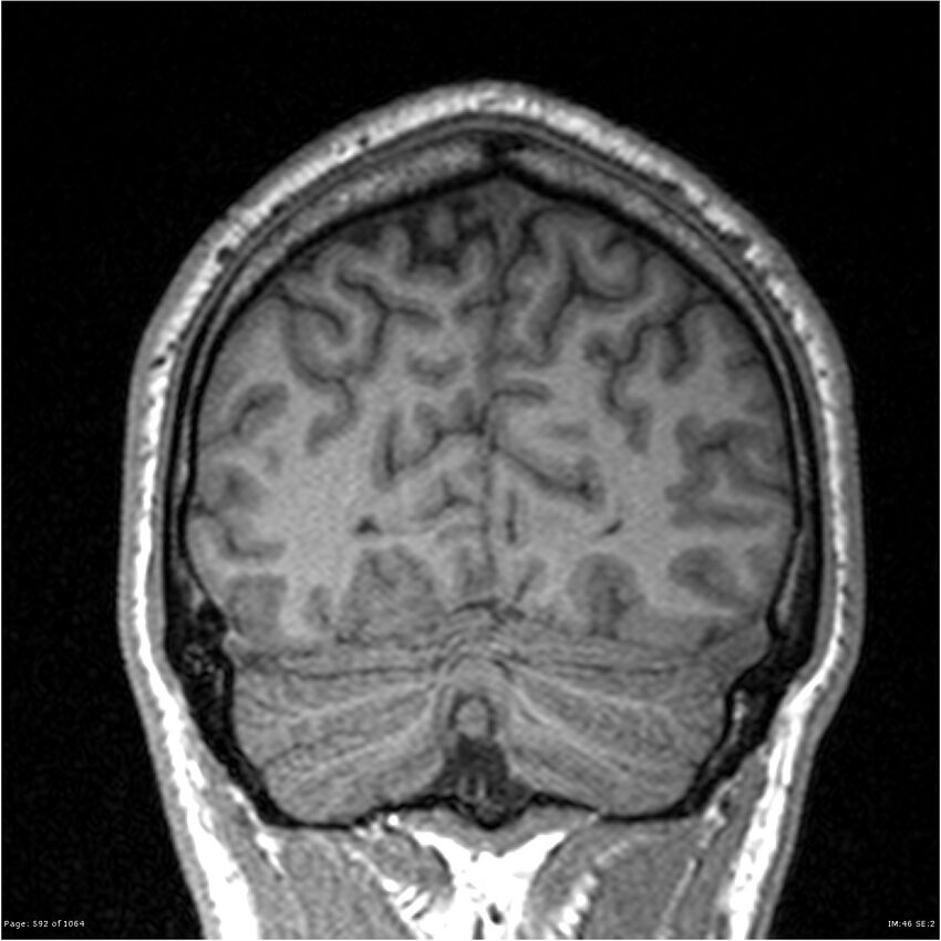 Normal brain MRI (non-focal epilepsy protocol) (Radiopaedia 38571-40700 Coronal T1 22).jpg