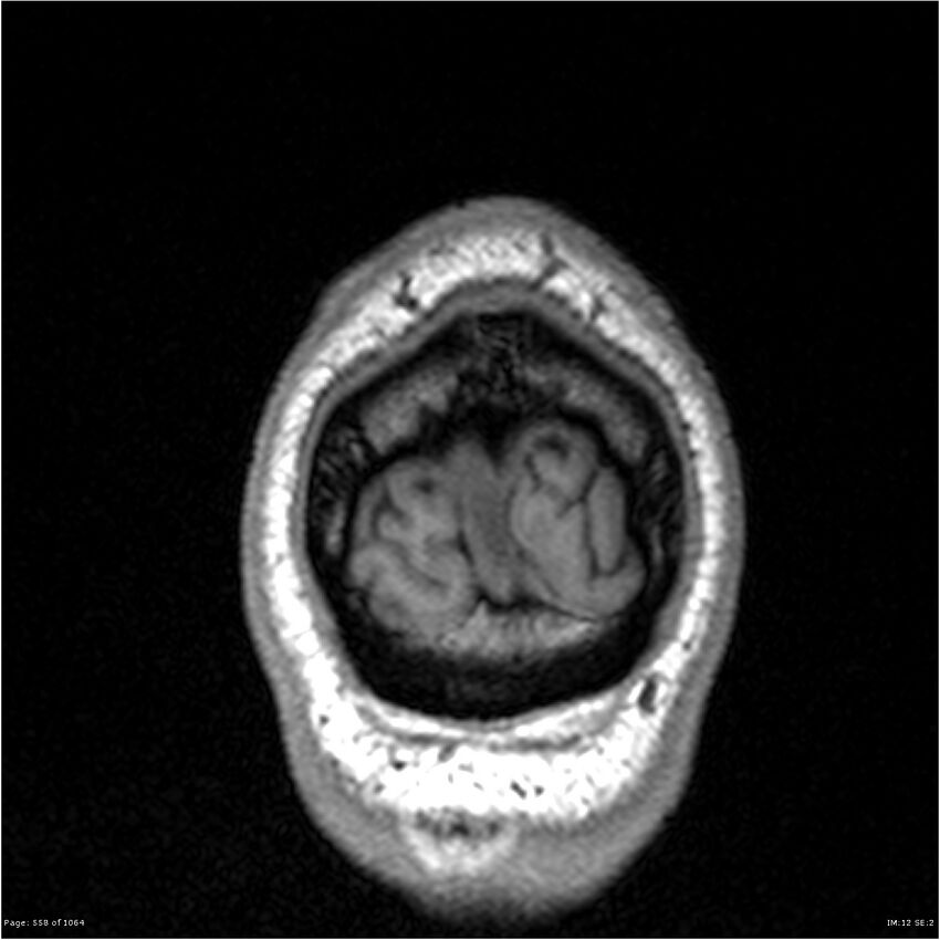Normal brain MRI (non-focal epilepsy protocol) (Radiopaedia 38571-40700 Coronal T1 5).jpg