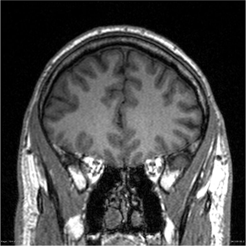 Normal brain MRI (non-focal epilepsy protocol) (Radiopaedia 38571-40700 Coronal T1 78).jpg