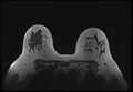Normal breast MRI - dense breasts (Radiopaedia 80454-93850 Axial T1 153).jpg