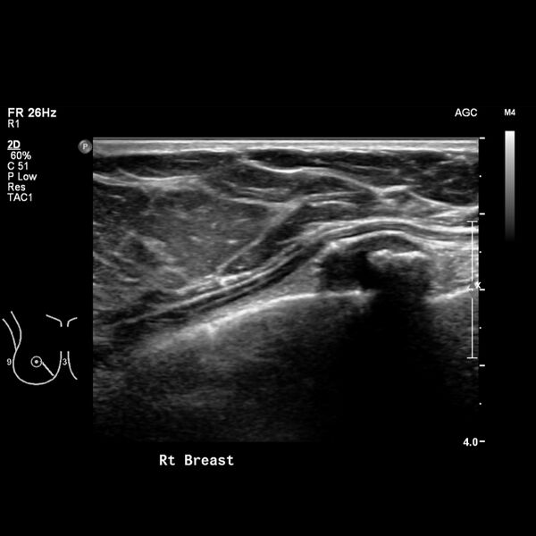 File:Normal breast mammography (tomosynthesis) and ultrasound (Radiopaedia 65325-74354 Right breast 6).jpeg