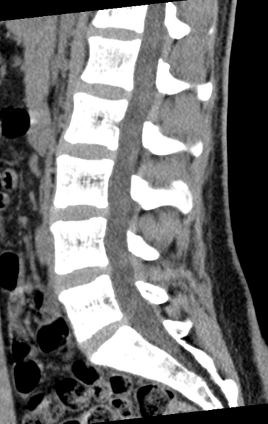 File:Normal lumbar spine CT (Radiopaedia 46533-50986 C 55).png