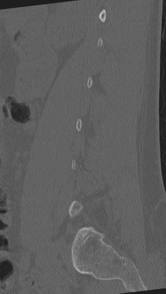 File:Normal lumbar spine CT (Radiopaedia 46533-50986 Sagittal bone window 74).png