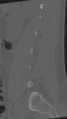 Normal lumbar spine CT (Radiopaedia 46533-50986 Sagittal bone window 74).png