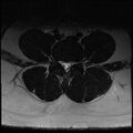 Normal lumbar spine MRI (Radiopaedia 47857-52609 Axial T2 19).jpg
