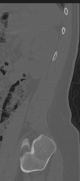 File:Normal lumbosacral CT (Radiopaedia 37923-39867 Sagittal bone window 13).png