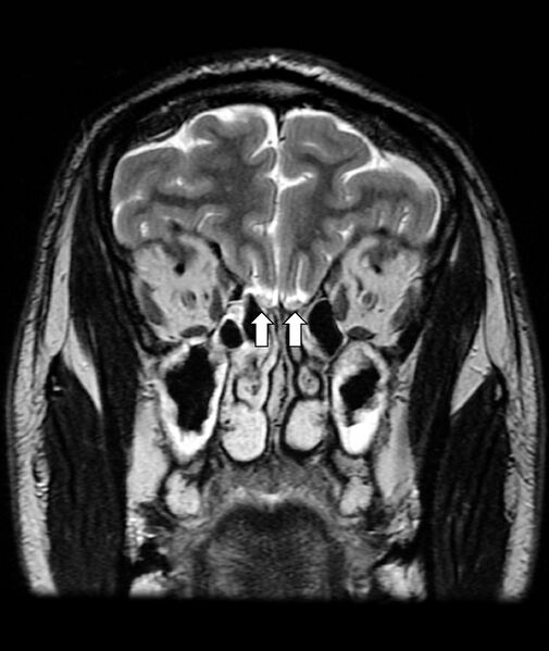 File:Normal olfactory nerves - annotated image (Radiopaedia 12575).jpg
