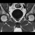 Normal prostate (MRI) (Radiopaedia 29986-30535 Coronal T1 6).jpg