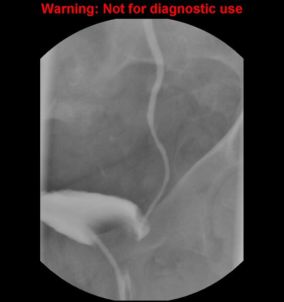 File:Normal retrograde pyelography of a native and transplant kidney (Radiopaedia 40480-43054 Native kidney 25).jpg