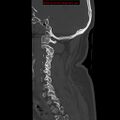 Occipital condyle fracture (Radiopaedia 18366-18208 Sagittal bone window 10).jpg