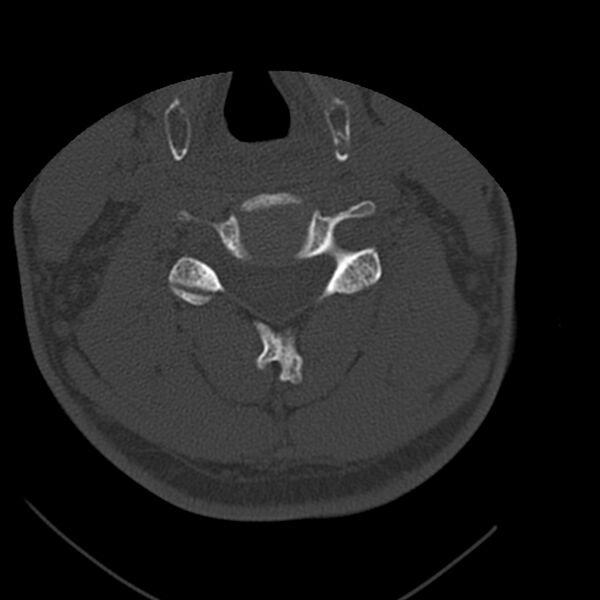 File:Occipital condyle fracture (Radiopaedia 31755-32691 Axial bone window 45).jpg