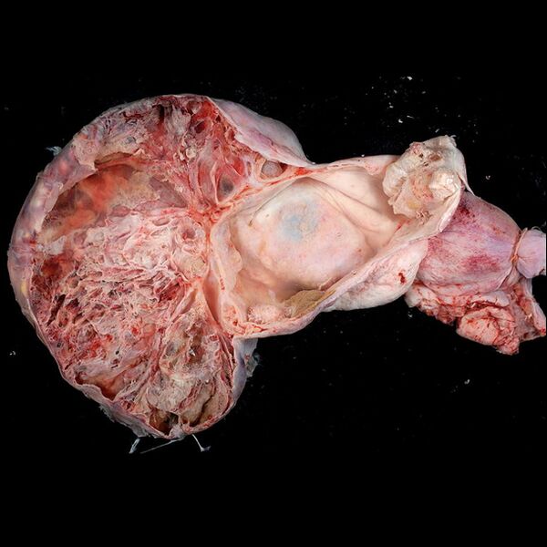 File:Ovarian mucinous cystadenoma (gross pathology) (Radiopaedia 9581).jpg