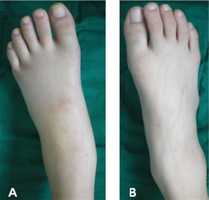 HLA-B27-associated reactive arthritis after Salmonella enteritis - a) swelling of left ankle joint b) and normal right ankle joint