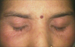 PPD contact dermatitis localized to eyelids.png