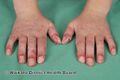 Systemic lupus erythematosus (DermNet NZ systemic-lupus-fingers).jpg