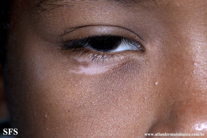 File:Vitiligo (Dermatology Atlas 44).jpg