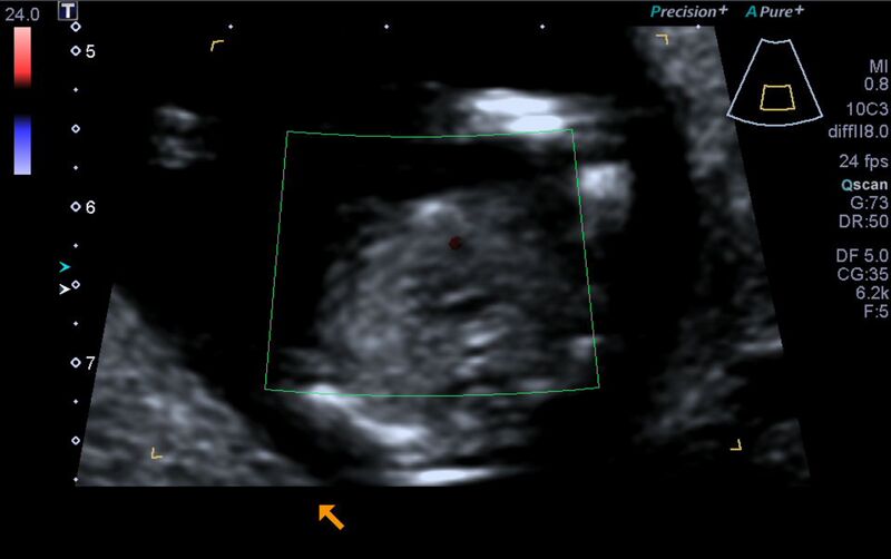 File:1st trimester nuchal-morphology ultrasound (Radiopaedia 44706-48477 Heart views cine with colour 133).jpg