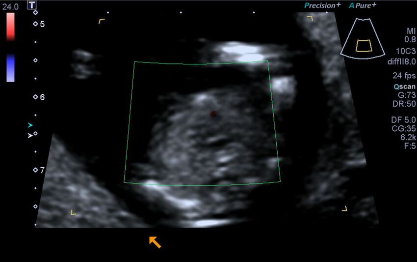 1st trimester nuchal-morphology ultrasound (Radiopaedia 44706-48477 Heart views cine with colour 133).jpg