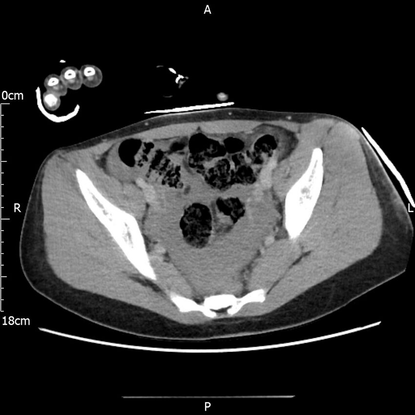 AAST grade IV kidney injury with CEUS follow-up (Radiopaedia 72353-82877 Axial C+ portal venous phase 64).jpg