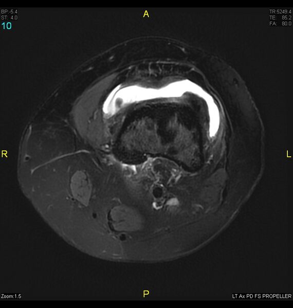 File:ACL mucoid degeration with cystic changes (Radiopaedia 48428-53341 Axial PD fat sat 7).jpg