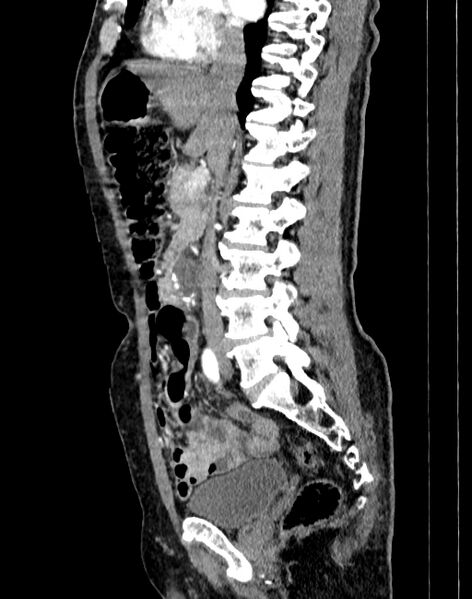 File:Abdominal aortic aneurysm (Radiopaedia 83581-98689 Sagittal C+ arterial phase 32).jpg
