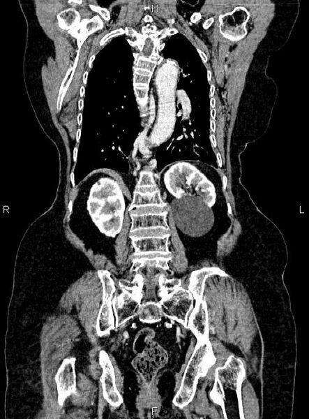 File:Abdominal aortic aneurysm (Radiopaedia 85063-100606 Coronal C+ arterial phase 42).jpg