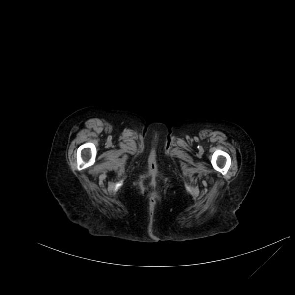File:Abdominal aortic aneurysm - impending rupture (Radiopaedia 19233-19246 Axial non-contrast 141).jpg