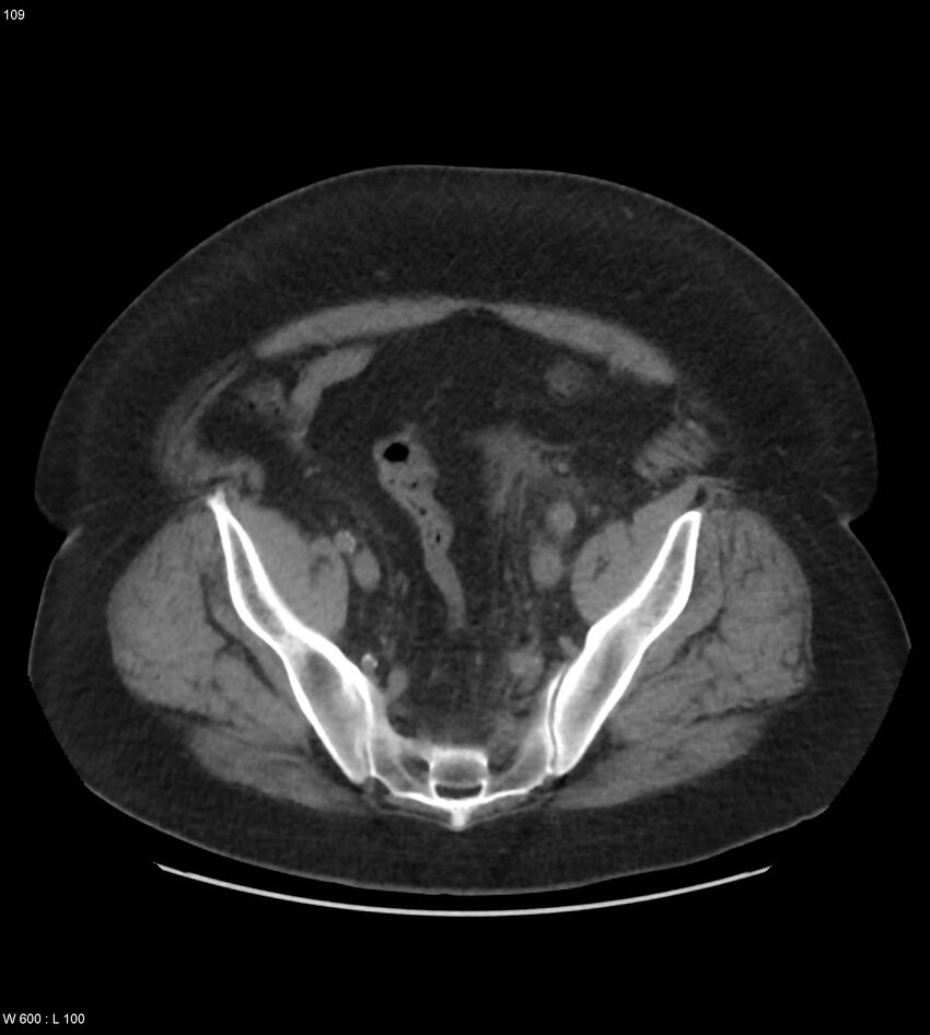 Abdominal aortic aneurysm with intramural hematoma then rupture (Radiopaedia 50278-55631 Axial non-contrast 105).jpg
