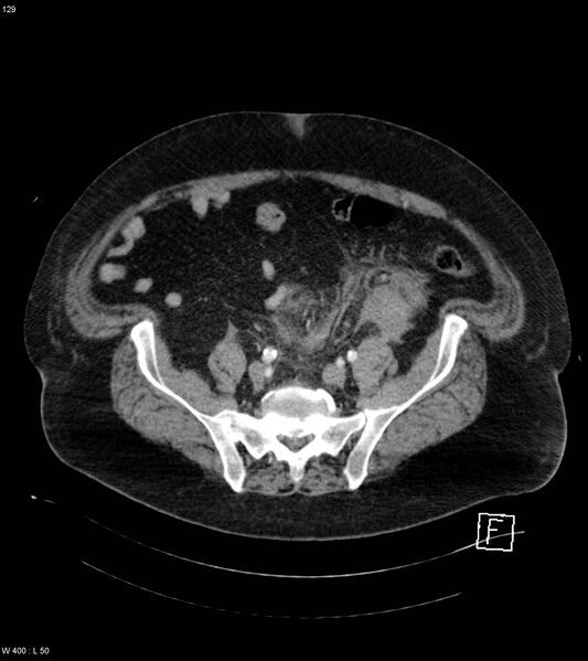 File:Abdominal aortic aneurysm with intramural hematoma then rupture (Radiopaedia 50278-55632 Axial C+ arterial phase 128).jpg