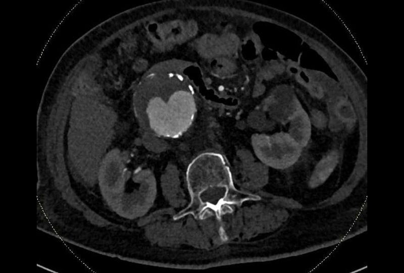 File:Abdominal aortic aneurysm with thrombus fissuration (Radiopaedia 73192-83919 Axial C+ arterial phase 81).jpg