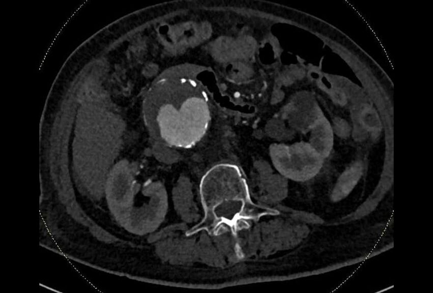 Abdominal aortic aneurysm with thrombus fissuration (Radiopaedia 73192-83919 Axial C+ arterial phase 81).jpg