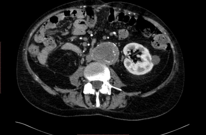 File:Abdominal aortic interposition tube graft and aneurysm thrombosis (Radiopaedia 71438-81857 Axial C+ arterial phase 87).jpg