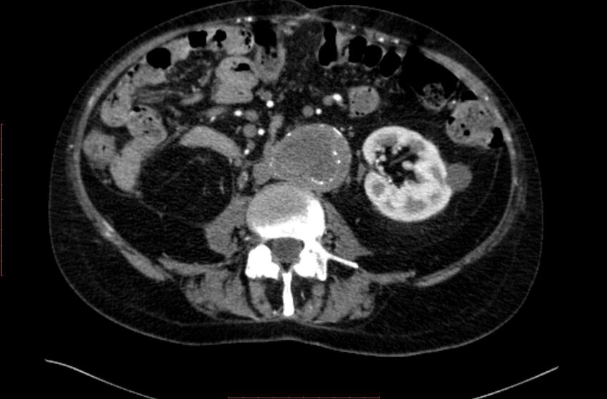 Abdominal aortic interposition tube graft and aneurysm thrombosis (Radiopaedia 71438-81857 Axial C+ arterial phase 87).jpg