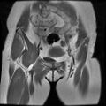 Abdominal wall endometriosis (Radiopaedia 83702-98847 Coronal T1 3).jpg