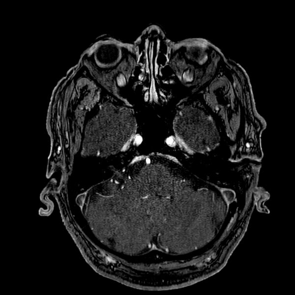 File:Accessory middle cerebral artery (Radiopaedia 73114-83828 Axial MRA 34).jpg