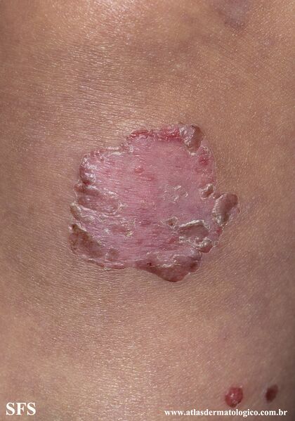 File:Acrodermatitis Enteropathica (Dermatology Atlas 52).jpg