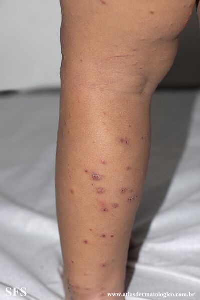File:Acrodermatitis Infantile Papular (Dermatology Atlas 22).jpg