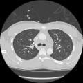 Active right ventricular cardiac sarcoidosis (Radiopaedia 55596-62101 Axial lung window 12).jpg