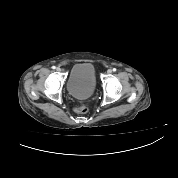 File:Acute-on-chronic Crohn disease with enteroenteric fistula (Radiopaedia 66686-75987 B 79).jpg