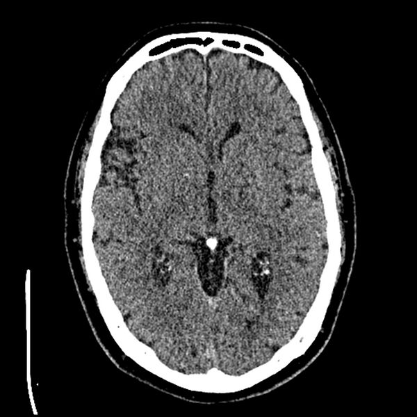 File:Acute A3 occlusion with ACA ischemic penumbra (CT perfusion) (Radiopaedia 72036-82525 Axial non-contrast thins 27).jpg