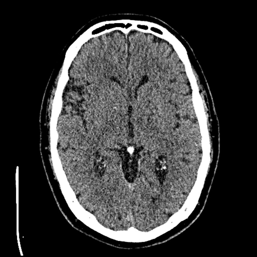 Acute A3 occlusion with ACA ischemic penumbra (CT perfusion) (Radiopaedia 72036-82525 Axial non-contrast thins 27).jpg